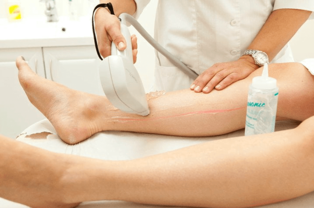 Laser hårfjerning på ben med LightSheer DUET hos Oslo Kosmetiske Lasersenter - profesjonell behandling med kjølegél